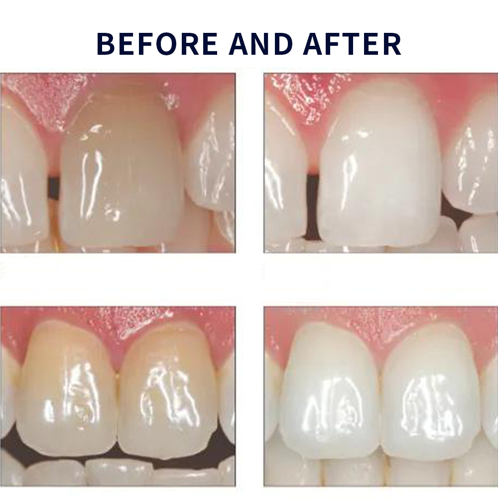 Opalescence Whitening 20% PF 2 - Teeth Whitening At Home review and price