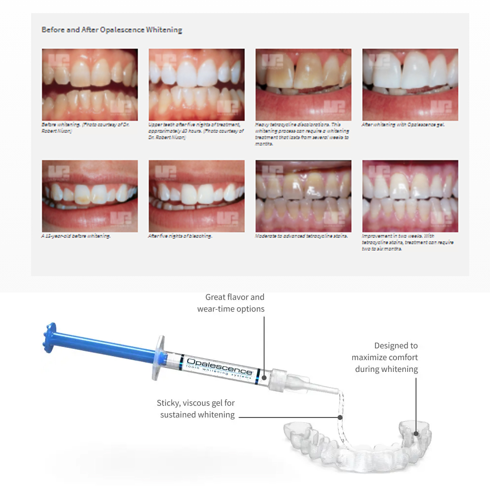Opalescence Whitening 20% PF 2 - Teeth Whitening At Home review and price