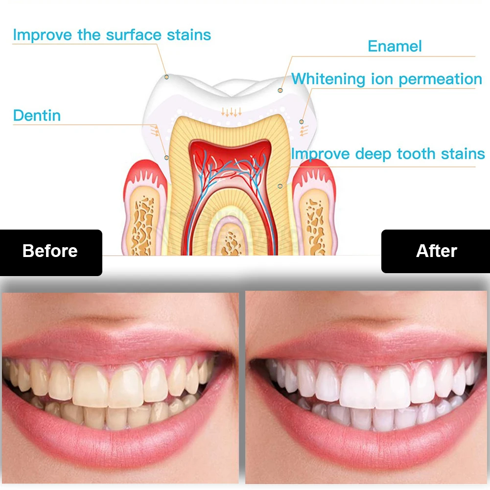 Dental Teeth Whitening Kit Min - Teeth Whitening App review and price